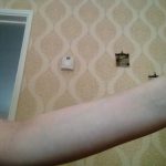 Catherine B - Eczema on arm (after)