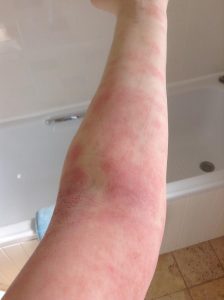 Catherine B - Eczema on arm (before)