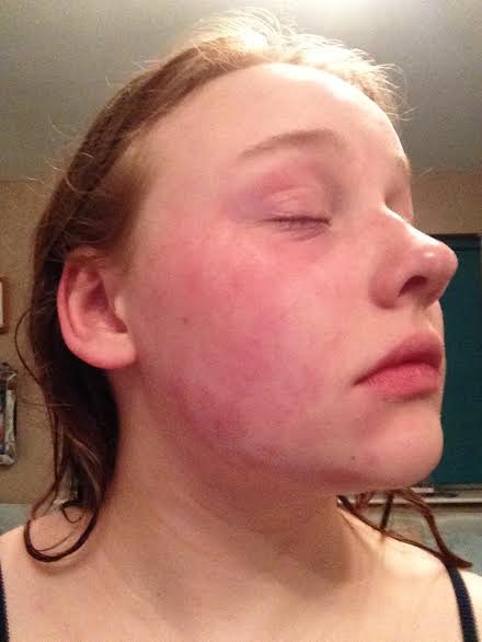 Catherine B - Eczema on face (before)